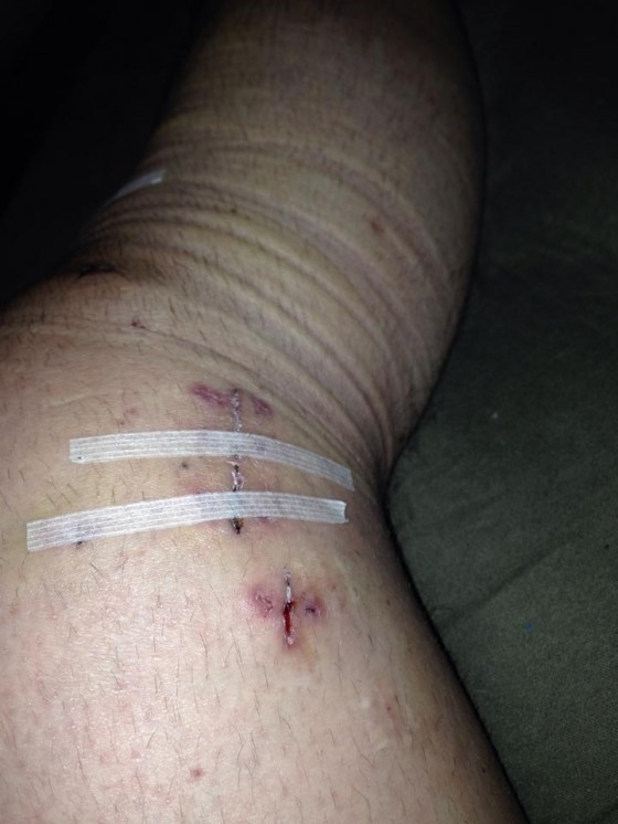 Kevin Fulton's knee one week after surgery